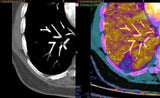 IQon Spectral CT ahora a todo color Philips