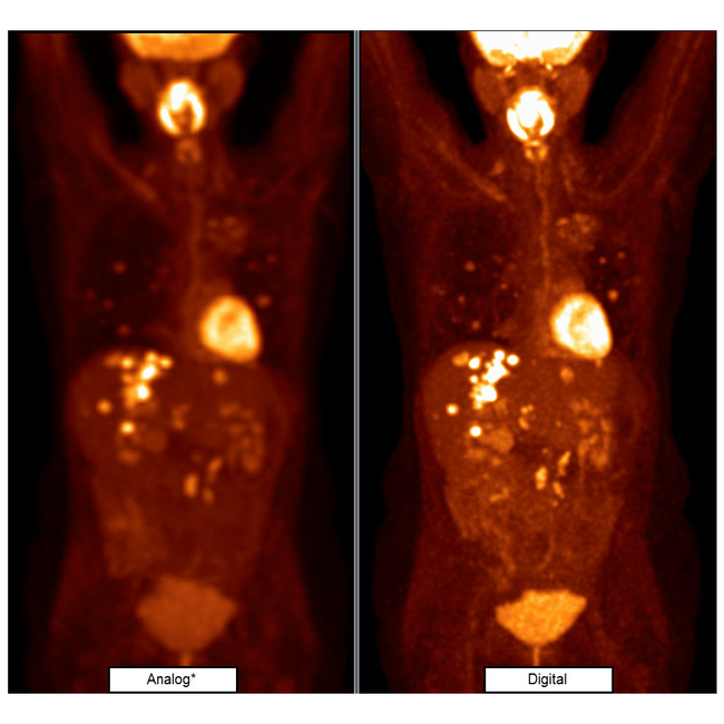 Escáner Molecular Vereos PET/CT Digital Philips