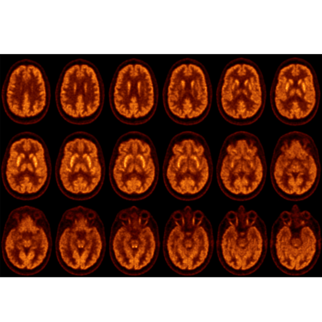 Escáner Molecular Vereos PET/CT Digital Philips