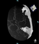 VasoCT Herramienta intervencional Rayos X