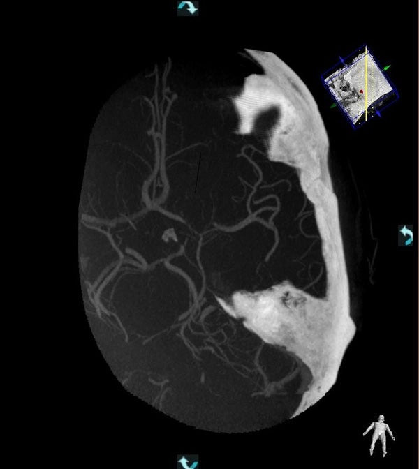 VasoCT Herramienta intervencional Rayos X
