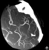 VasoCT Herramienta intervencional Rayos X
