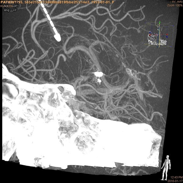 VasoCT Herramienta intervencional Rayos X