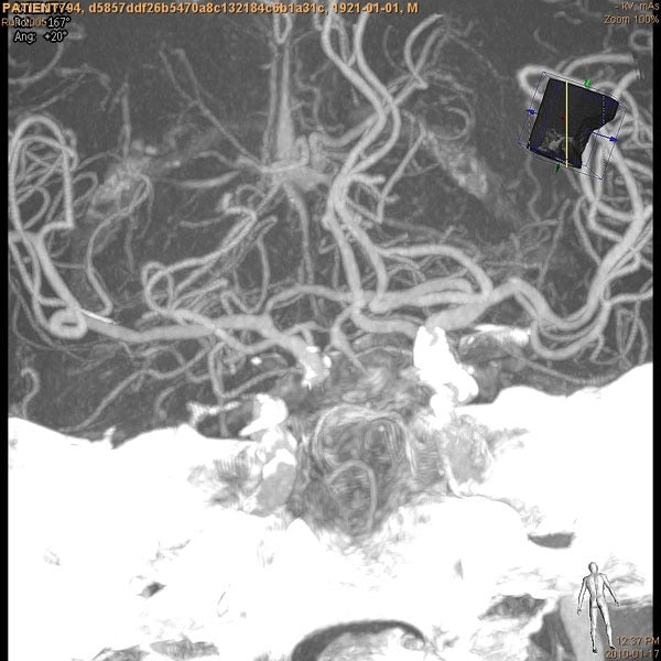 VasoCT Herramienta intervencional Rayos X