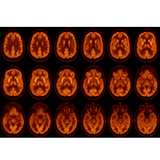 Escáner Molecular Vereos PET/CT Digital Philips